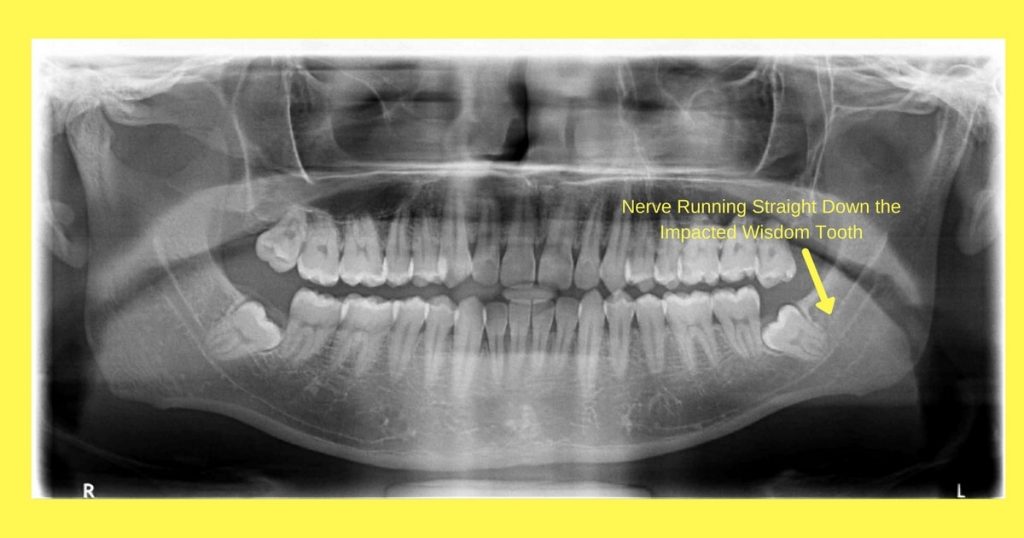 does-wisdom-teeth-removal-cause-nerve-damage-or-dental-paresthesia