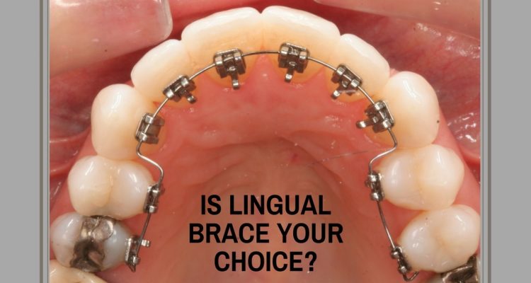 Is Lingual Brace your choice? - Expert Dental Care
