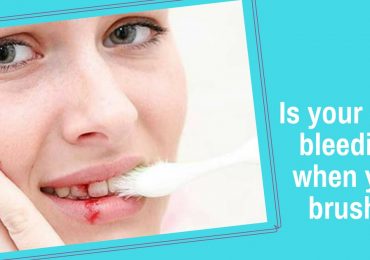 Reasons for Bleeding Gums. What to do if there is bleeding gums