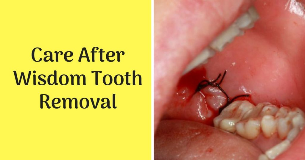 is wisdom teeth removal painful