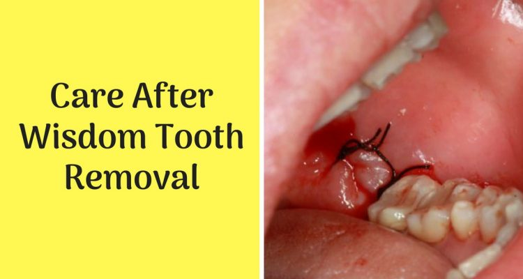 Wisdom Teeth Extraction Recovery Timeline