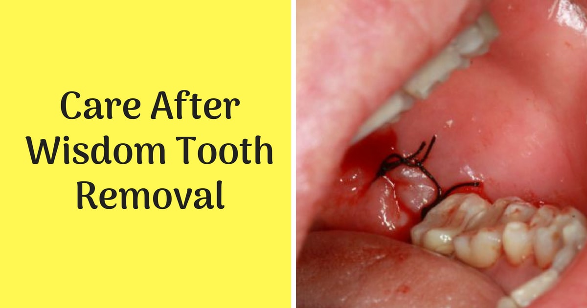 post wisdom teeth removal care gauze