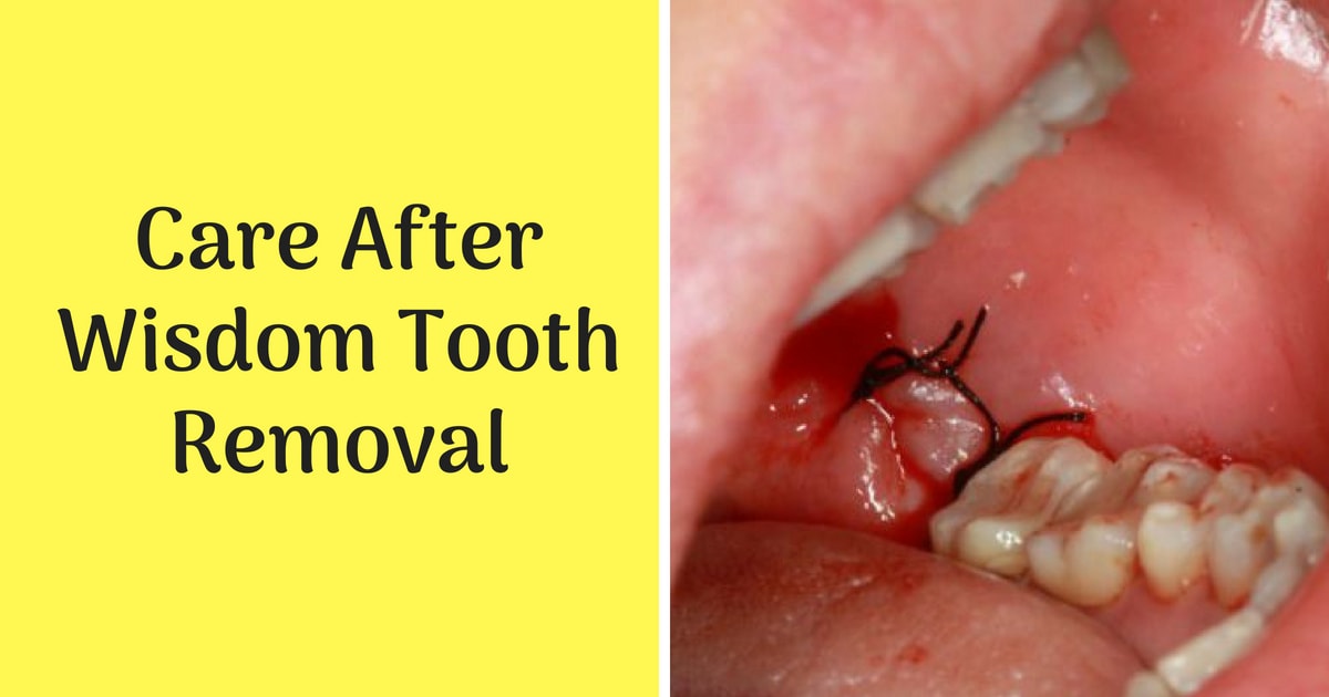 Wisdom Tooth Removal Recovery Steps