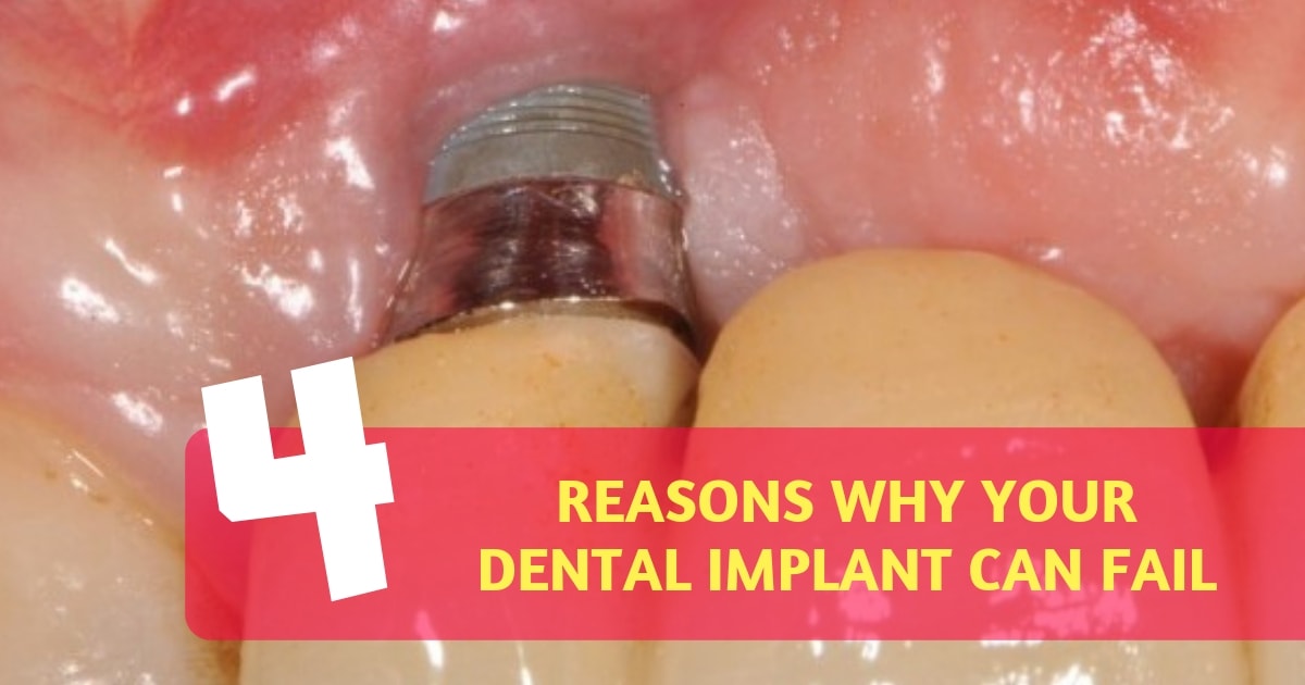 4-common-reasons-why-dental-implants-can-fail-expert-dental-care