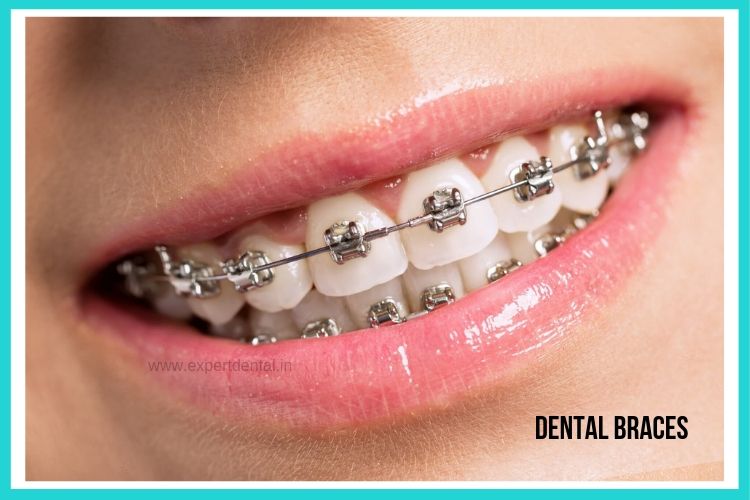Dental Braces (Orthodontics) - Expert Dental Care
