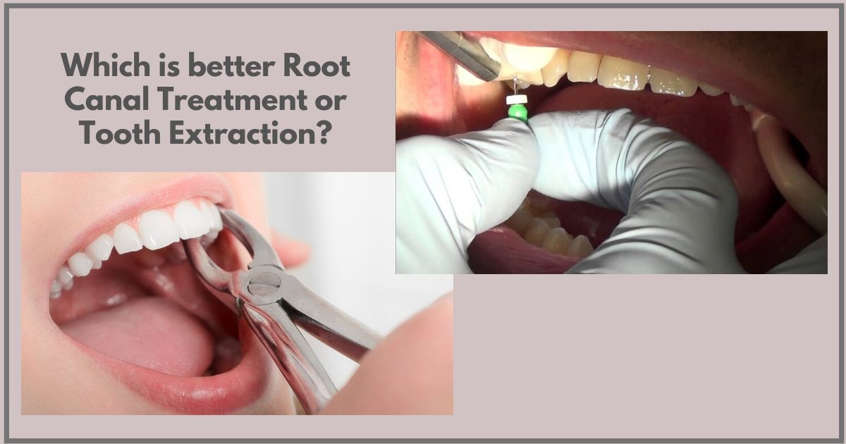 which-is-better-root-canal-treatment-or-extraction-expert-dental-care