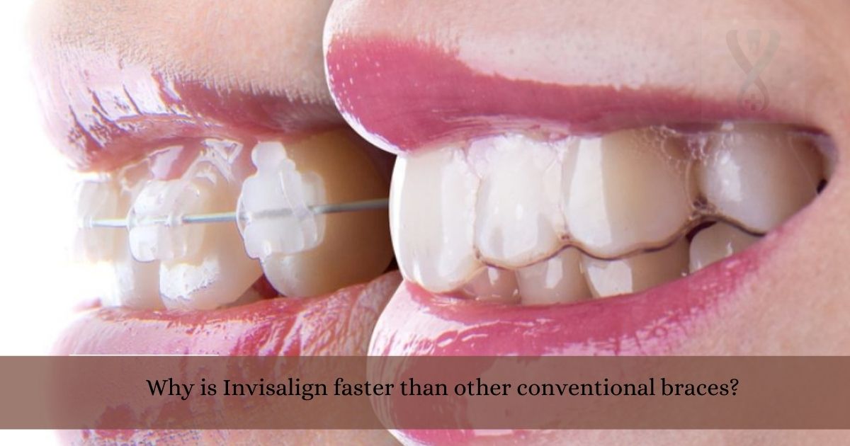 Why is Invisalign faster than other conventional braces? - Expert Dental  Care