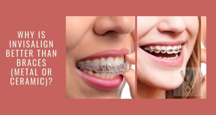 Metal Braces as An Orthodontic Treatment: A Qualified Orthodontist
