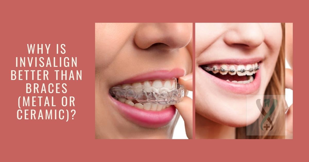 Why is Invisalign better than metal braces or ceramic braces?