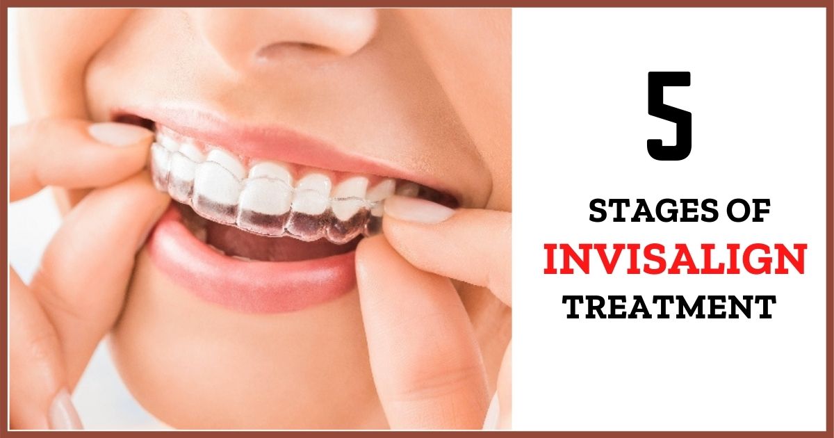 5 Stages in Invisalign Treatment