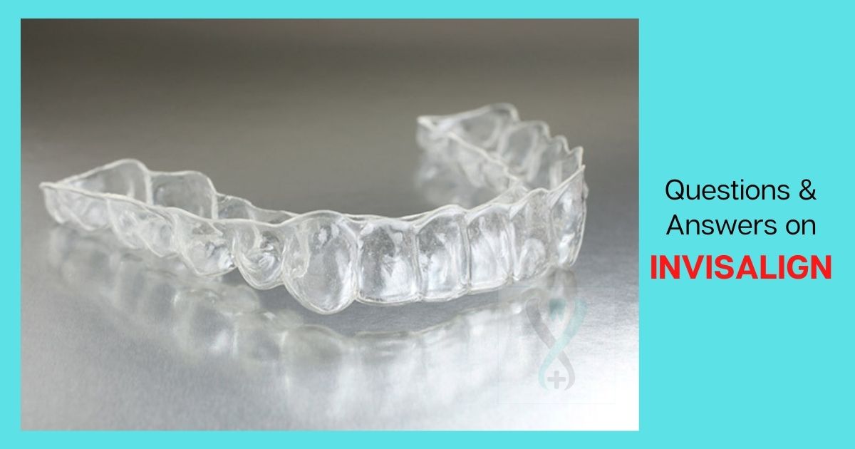 Questions & Answers on Invisalign