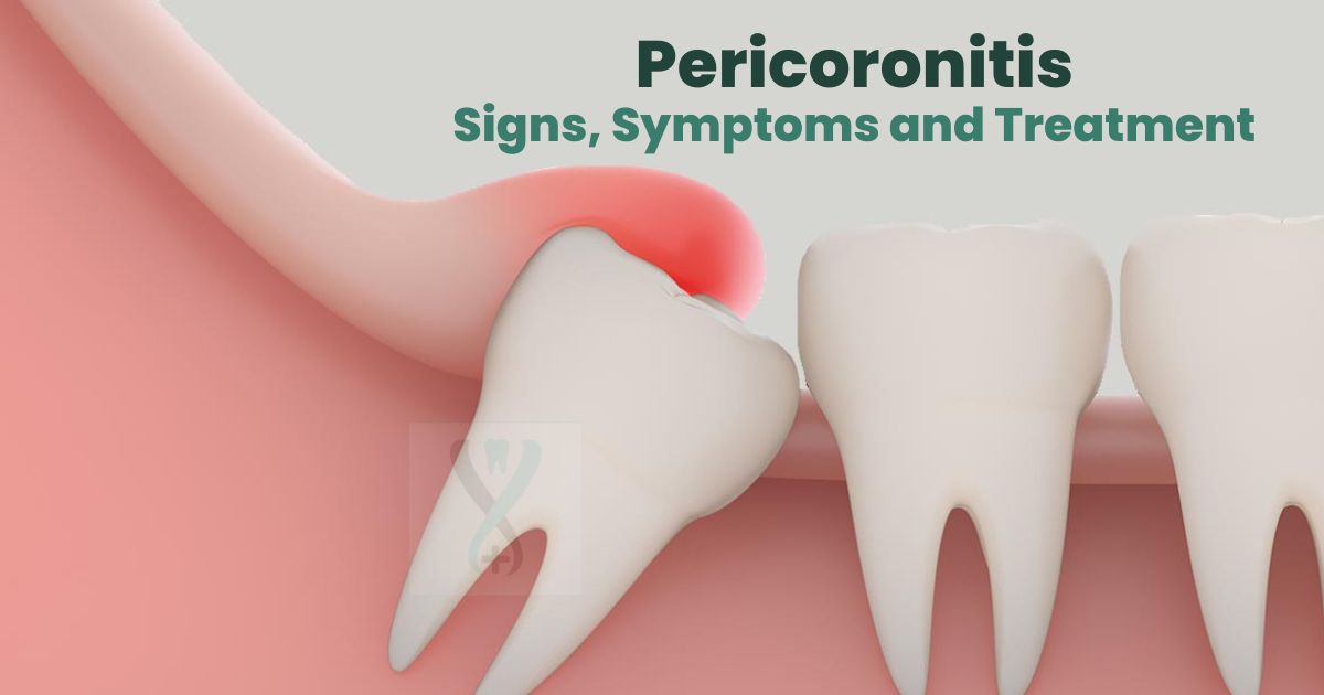 Pericoronitis Symptoms Causes And Treatments VYQCTM Pericoronitis Symptoms Causes And Treatments VYQCTM